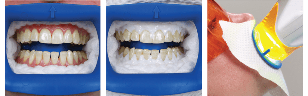Zoom Whitening What Is The Process And How Does It Work Zoom Whitening What Is The Process And How Does It Work