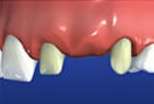 Teeth are prepared for dental bridge by removing tooth structure