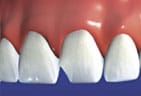 Teeth in need of a dental crown