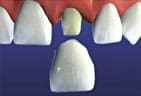 Dental crown is applied to the tooth