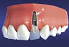 Customized Crown Created for Dental Implant