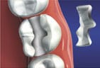 Porcelain Dental Inlay