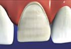 Tooth Is Prepped For Porcelain Dental Veneers