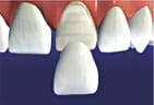 Tooth Fitted With Porcelain Dental Veneers