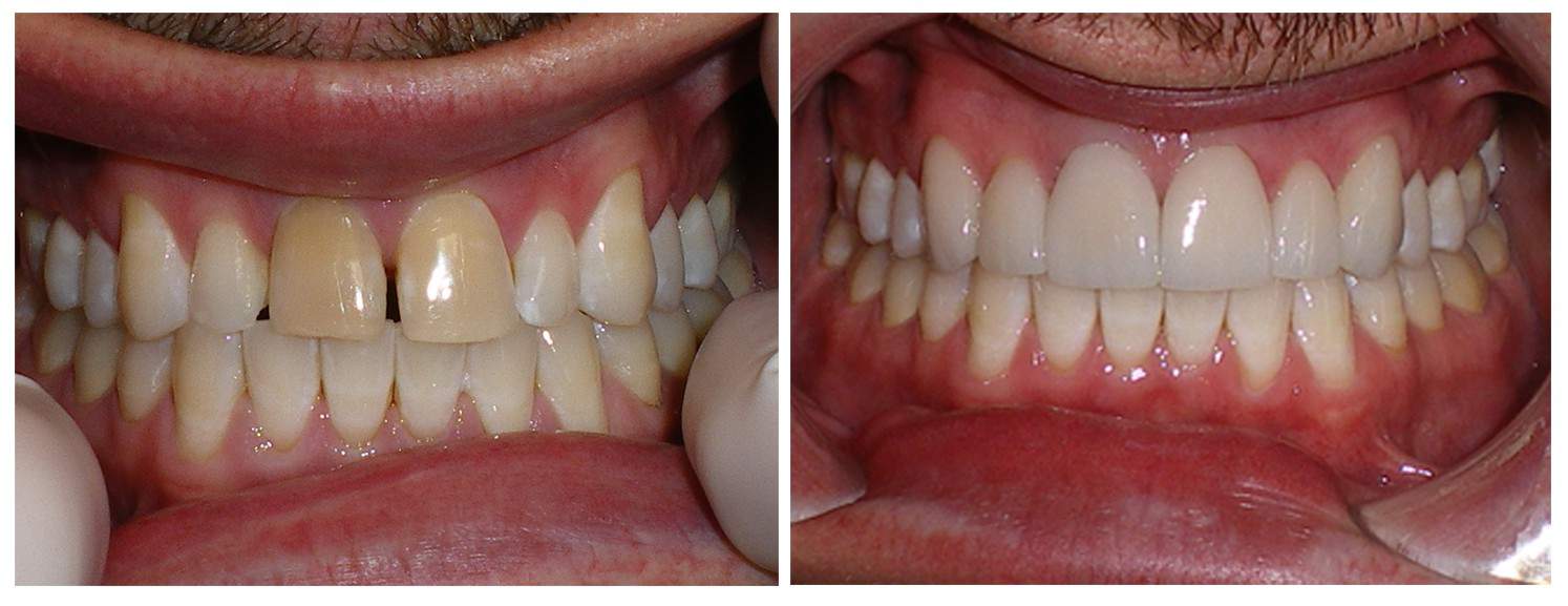 Before & After Dentistry at David L Evans in Boulder, CO