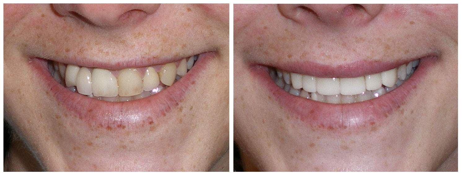 Before & After Cosmetic Dentistry at David L Evans in Boulder, CO