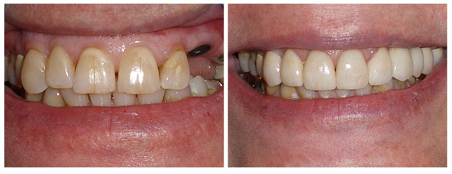 Before & After Dental Implant Restoration & Fixed Bridges