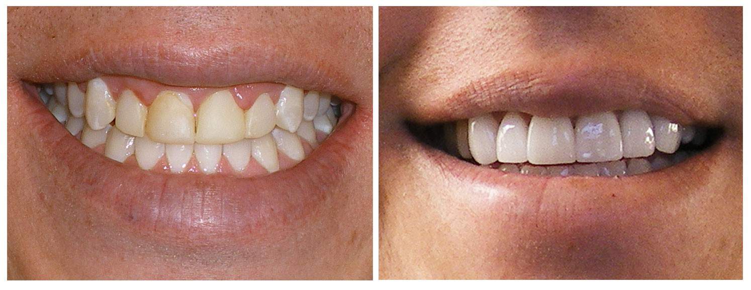 Before & After Teeth Bleaching