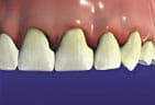 Teeth with Gingivitis in need of Periodontics