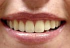 Before Professional Zoom Whitening in Boulder, CO