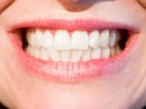 teeth whitening Dr. Dave Evans DDS