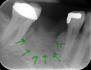 Green Arrows Highlighting the Bone Graft for Dental Implant