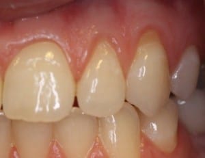 Teeth with Receding Gums, Before Gum Grafting