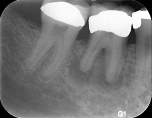 Tooth in Need of a Bone Graft & Dental Implant