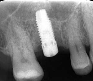 Dental Implants Boulder, CO