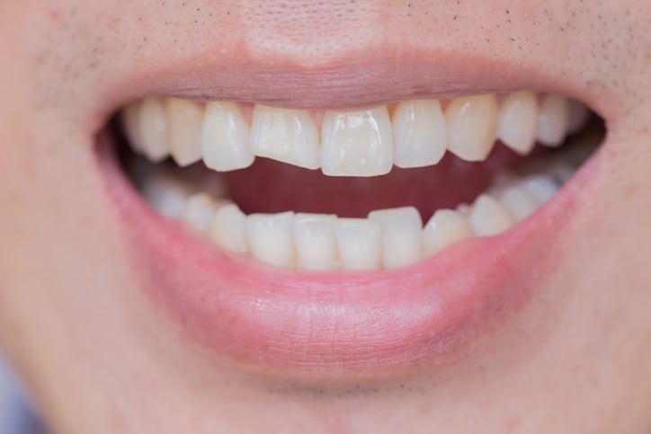 Chipped & Broken Teeth - Cosmetic and Restorative Dentist Boulder, CO